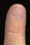 Henri's left thumb