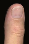 Henri's right thumb