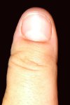 Katrin's left thumb