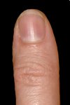 Ute's left thumb
